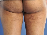 Parapsoriasis retiformis