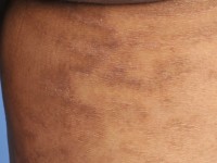 Parapsoriasis retiformis