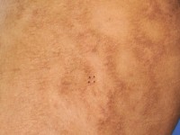 Parapsoriasis retiformis