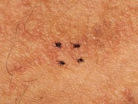 Parapsoriasis retiformis