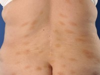 Small plaque parapsoriasis