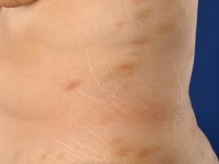 Small plaque parapsoriasis