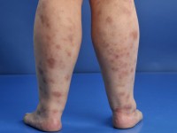 Small plaque parapsoriasis