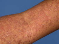 Small plaque parapsoriasis