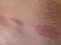 Small plaque parapsoriasis