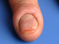 Paronychia