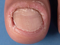 Paronychia