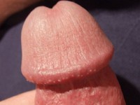 Pearly penile papules, hirsuties papillaris penis