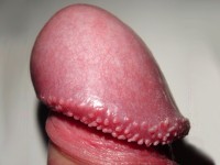 Pearly penile papules, hirsuties papillaris penis