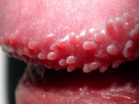 Pearly penile papules, hirsuties papillaris penis