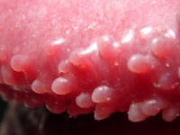 Pearly penile papules, hirsuties papillaris penis