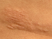 peau de chagrin bij tubereuze sclerose