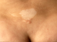 peau de chagrin en ash leave macule bij tubereuze sclerose