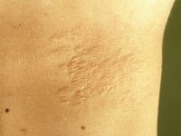 peau de chagrin bij tubereuze sclerose