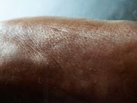 peau d'orange aspect