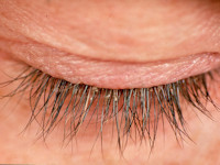 Hoofdluis, pediculosis capitis