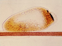 Head lice, pediculosis capitis