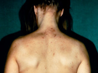 Hoofdluis, pediculosis capitis