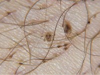 Pubic lice