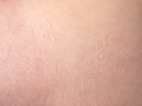 Peeling skin syndrome