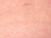 Peeling skin syndrome