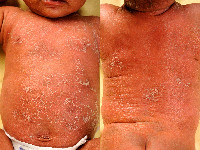 Peeling skin syndrome