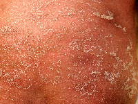Peeling skin syndrome