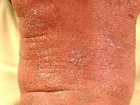 Peeling skin syndrome