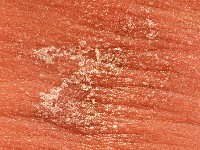 Peeling skin syndrome