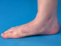 Peeling skin syndrome