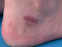 Peeling skin syndrome