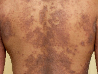 Pellagra, huidafwijkingen bij vitamine B3 tekort