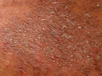 Pellagra, huidafwijkingen bij vitamine B3 tekort