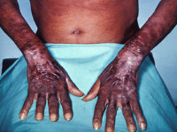 Pellagra, huidafwijkingen bij vitamine B3 tekort