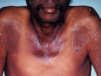 Pellagra, huidafwijkingen bij vitamine B3 tekort