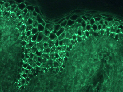Immunofluorescence in pemphigus vulgaris