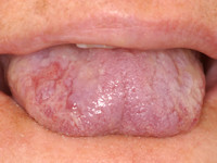 Pemphigus mondholte