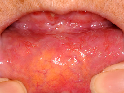 Pemphigus mondholte