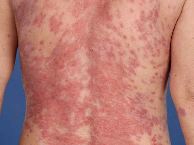 Pemphigus vulgaris