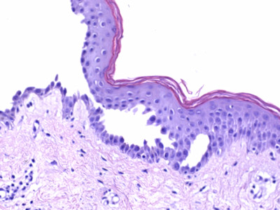 Histologie van pemphigus vulgaris