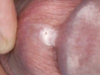 Penile intraepithelial neoplasia