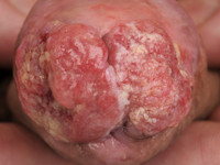 Peniscarcinoom