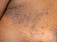 Perforating folliculitis