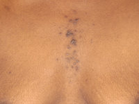 Perforating folliculitis
