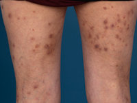 Perforating folliculitis