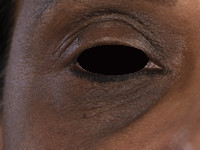 Atopisch eczeem bij donkere huid, periorbitale hyperpigmentatie