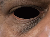 Atopisch eczeem bij donkere huid, periorbitale hyperpigmentatie