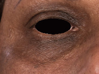 Atopisch eczeem bij donkere huid, periorbitale hyperpigmentatie