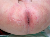 Peri-anaal eczeem, eczema ani