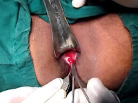 Perianal fistula